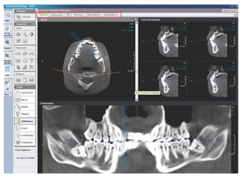 Modul Dental - Software OnDemand3D
