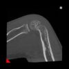 Computer Tomograf NewTom 7G cu tehnologie CBCT - Fractura trohleara pediatrica