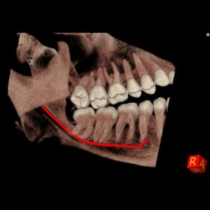 Computer Tomograf NewTom 7G cu tehnologie CBCT - Canal Mandibular