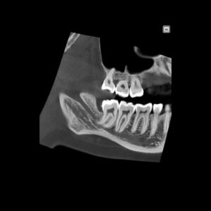 Radiologie NewTom - Canal Mandibular