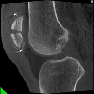 Fractura de rotula- Radiologie 7G NewTom