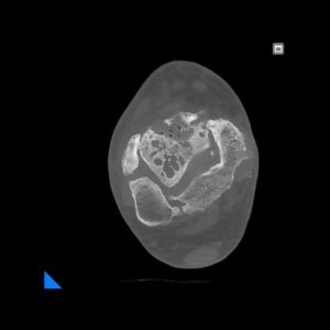 Radiologie NewTom - Glezna osteoporotica articulara