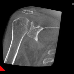 Radiologie NewTom - Osteoartrita la nivelul umarului