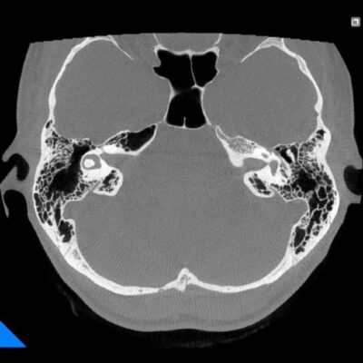 SSC lateral si articulatie malleus-incus - Radiologie 7G