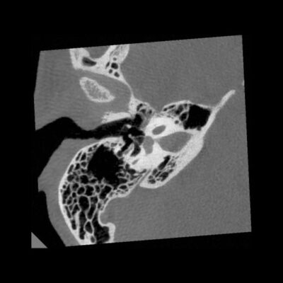 Radiologie NewTom 7G - Urechea mijlocie