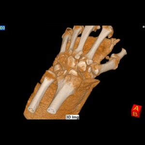 Radiologie NewTom - Vindecarea incheieturii cu gips