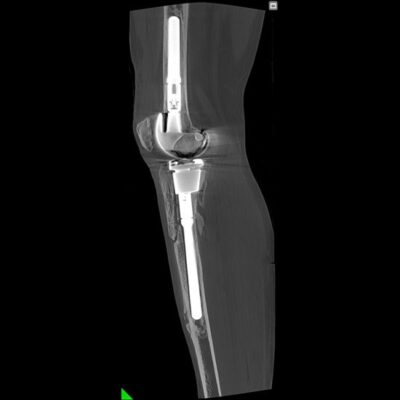 Proteza de genunchi intermodulara