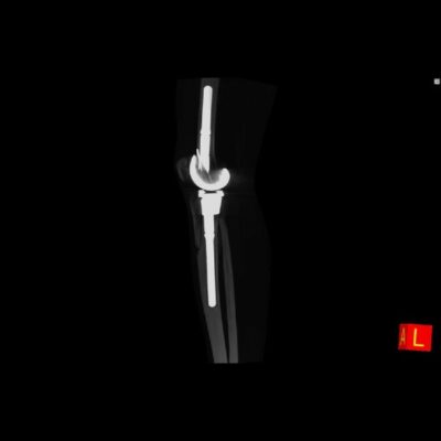Proteza de genunchi intermodulara NewTom