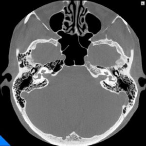 Computer Tomograf NewTom 7G cu tehnologie CBCT - Os temporal bilateral