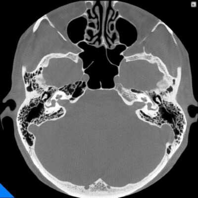 Radiologie Netom 7G - Os temporal bilateral