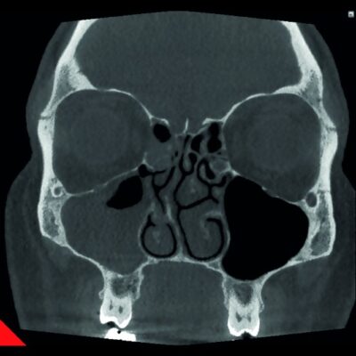 Radiologie NewTom 7G - Sinuzita si deviatie de sept