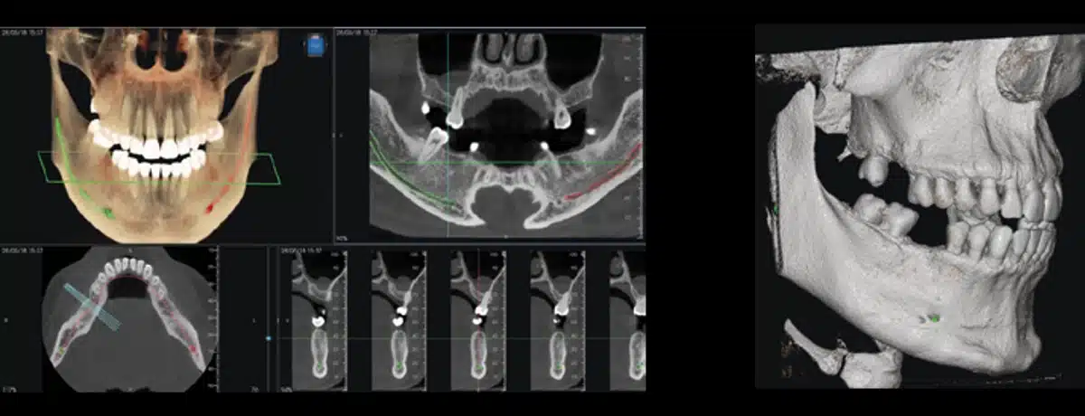 Instalatie radiologica NewTom VG-ONE 2D/3D cu brat CEPH
