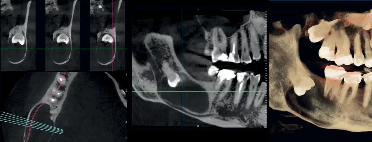 Instalatie radiologica NewTom VG-ONE 2D/3D cu brat CEPH