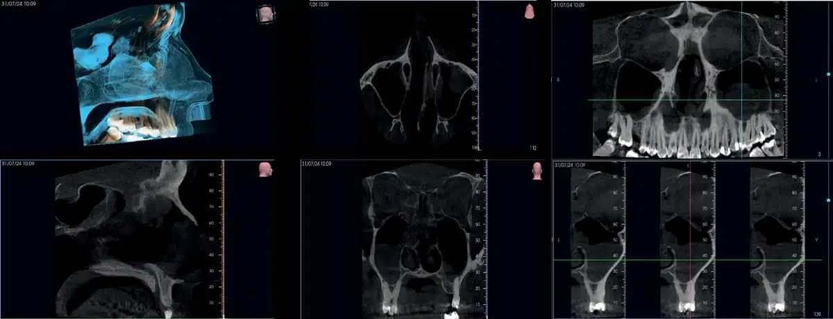 Instalatie radiologica NewTom VG-ONE 2D/3D cu brat CEPH
