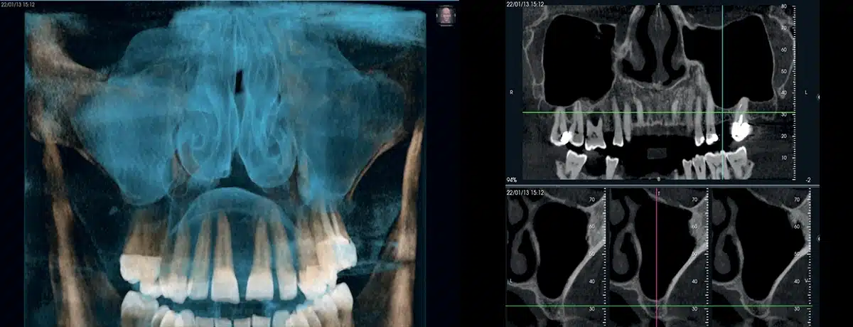 Instalatie radiologica NewTom VG-ONE 2D/3D cu brat CEPH