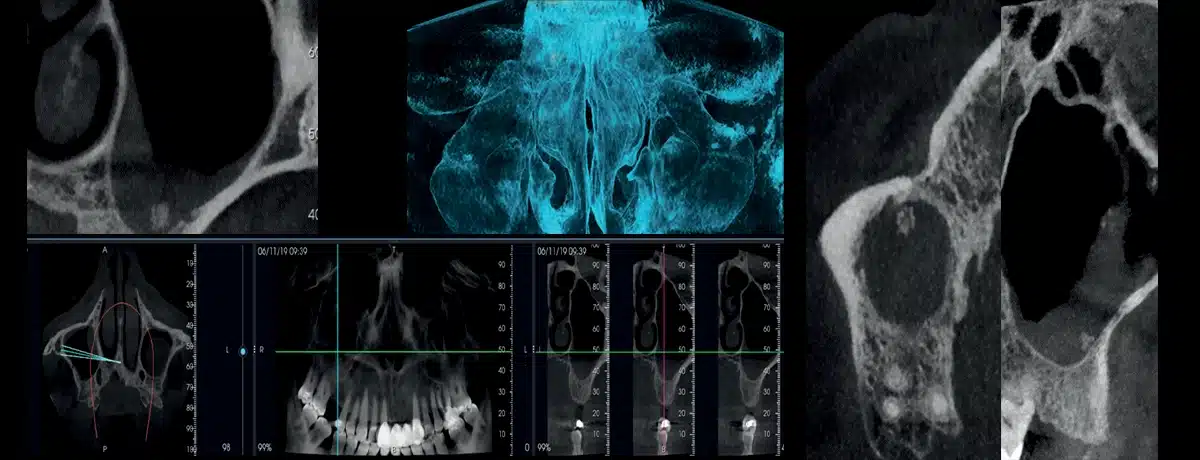 Instalatie radiologica NewTom VG-ONE 2D/3D cu brat CEPH